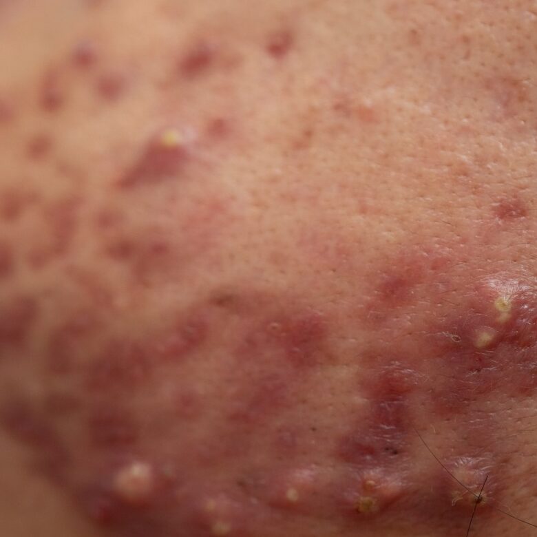 Acne on face because the disorders of sebaceous glands productions. Acne or a Cosmetic