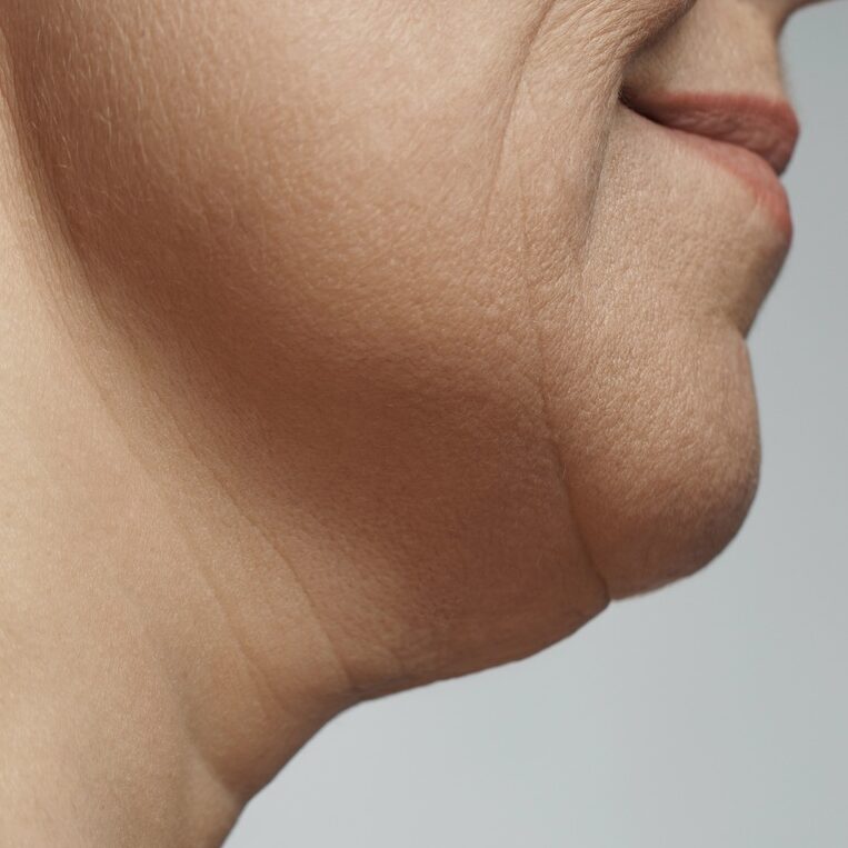 Double chi removal, facelift and neck liposuction
