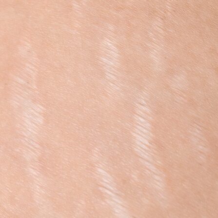 Female body with stretch marks close-up.