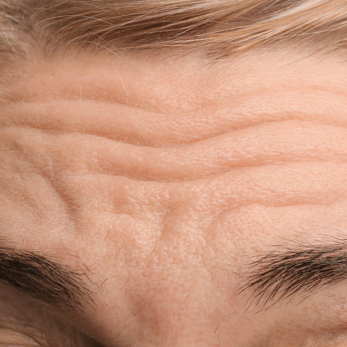 Female forehead with wrinkles
