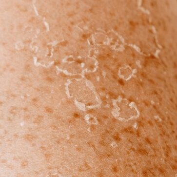 Peeling skin after sunburn, dermatology problems